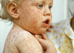 rashes_princ_6l7247_measles_424x302